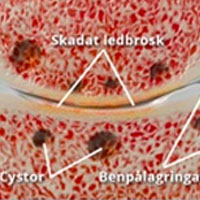 Rubrik Artros i höft och knä