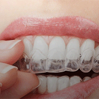Invisalign